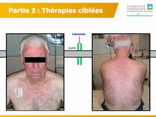 S5 - UE 2.9 - Les modalités de prise en charge thérapeutiques en cancérologie (4ème partie)