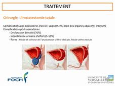 UE 2.9 - S5 - Cancer d'organe prostate et autres cancers urologiques