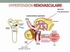 UE 2.8 Nephrologie (HYPERTENSION RENOVASCULAIRE coarctation)