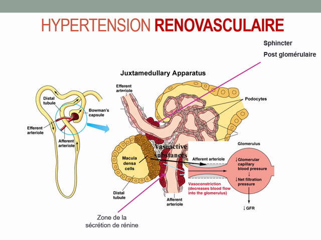 POD - UVSQ - Ue 2.8 Nephrologie (Hypertension Renovascula…